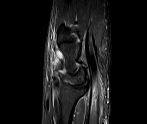 MRI wrist sagittal stir image 2 - MRI