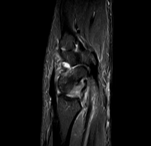 MRI wrist sagittal stir image 3 - MRI