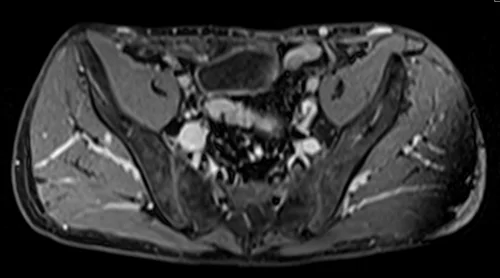 MRV abdomen axial t1 flash post contrast image 1 - MRI