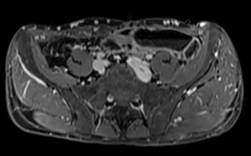 MRV abdomen axial t1 flash post contrast image 2 - MRI