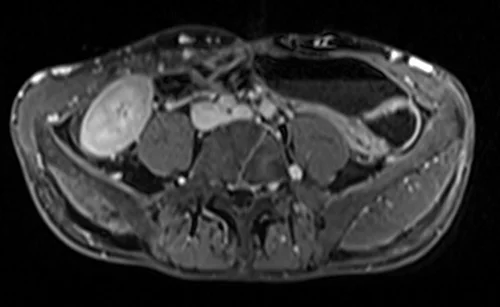 MRV abdomen axial t1 flash post contrast image 3 - MRI
