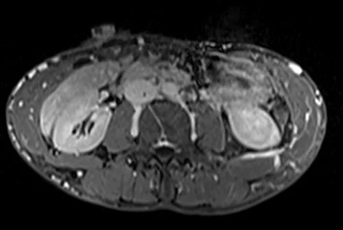 MRV abdomen axial t1 flash post contrast image 4 - MRI