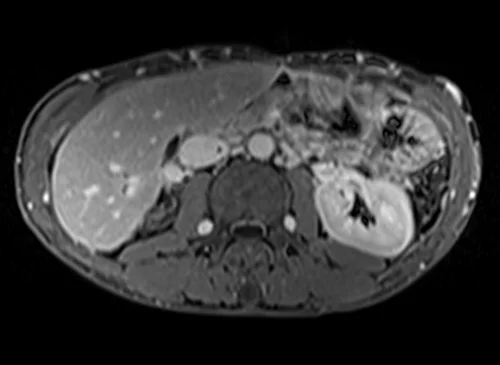 MRV abdomen axial t1 flash post contrast image 5 - MRI