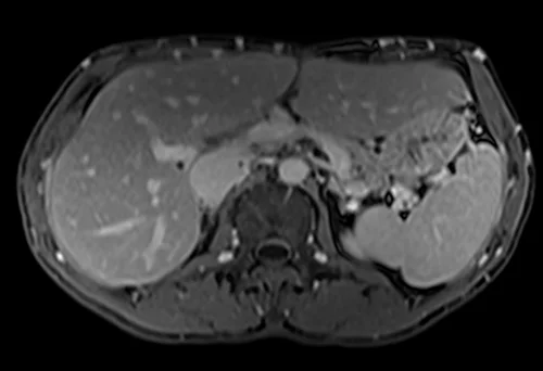 MRV abdomen axial t1 flash post contrast image 6 - MRI