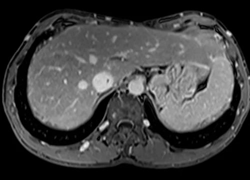 MRV abdomen axial t1 flash post contrast image 7 - MRI