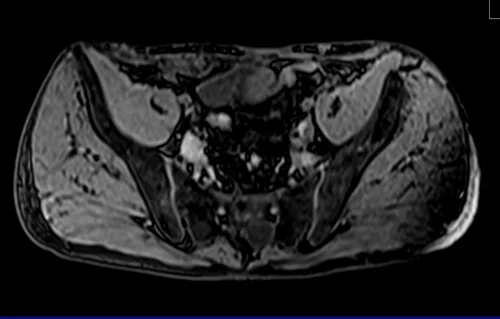 MRV abdomen axial t1 flash pre contrast image 1 - MRI