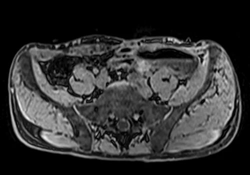 MRV abdomen axial t1 flash pre contrast image 2 - MRI