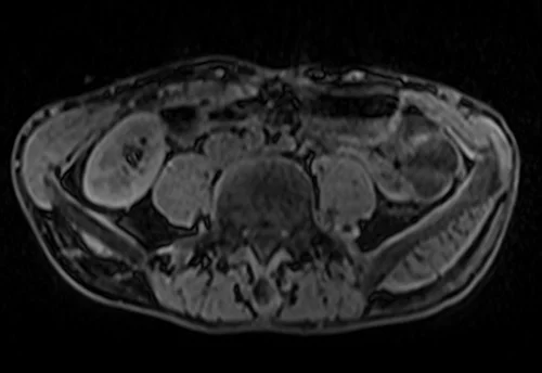 MRV abdomen axial t1 flash pre contrast image 3 - MRI
