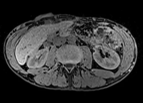 MRV abdomen axial t1 flash pre contrast image 4 - MRI