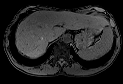 MRV abdomen axial t1 flash pre contrast image 7 - MRI