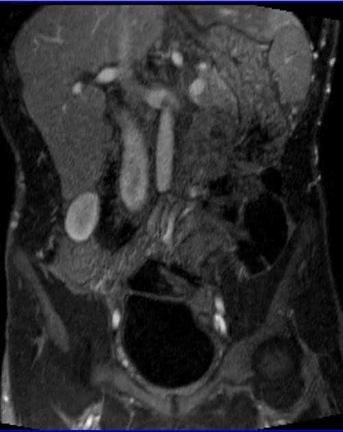 MRV abdomen coronal t1 flash post contrast image 1 - MRI