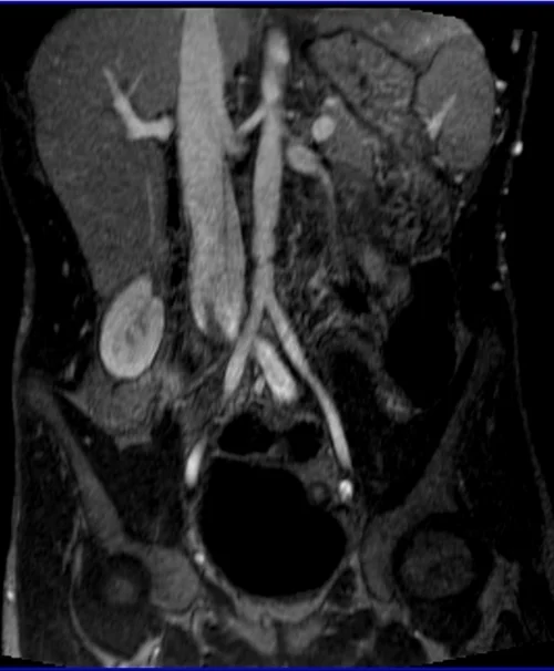 MRV abdomen coronal t1 flash post contrast image 2 - MRI