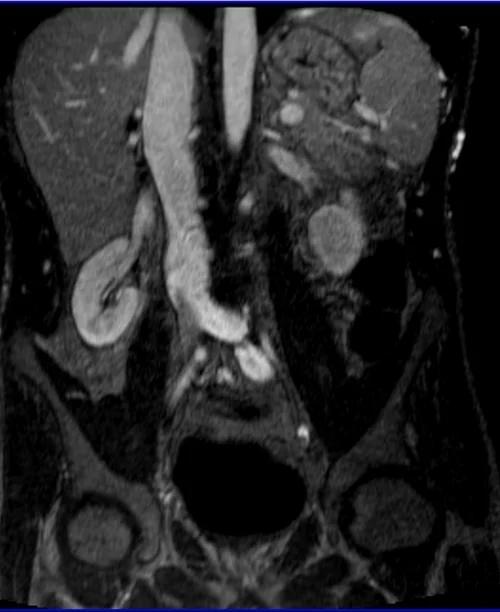 MRV abdomen coronal t1 flash post contrast image 3 - MRI