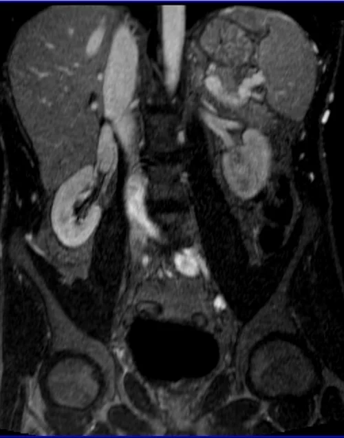 MRV abdomen coronal t1 flash post contrast image 4 - MRI
