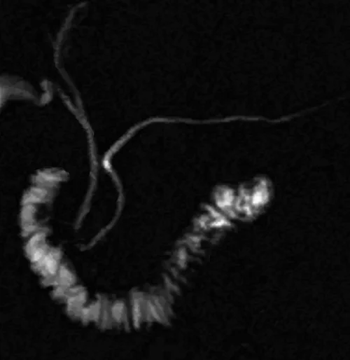 Secretin enhanced MRCP image 4 - MRI