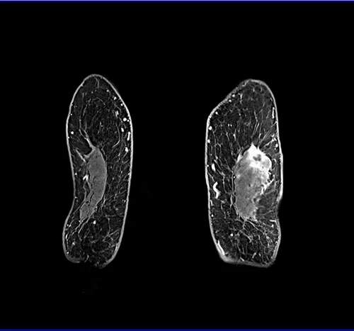 T1 CORONAL FAT SAT 1 - MRI