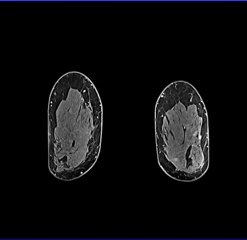 T1 CORONAL FAT SAT 2 - MRI