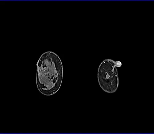 T1 CORONAL FAT SAT 3 - MRI