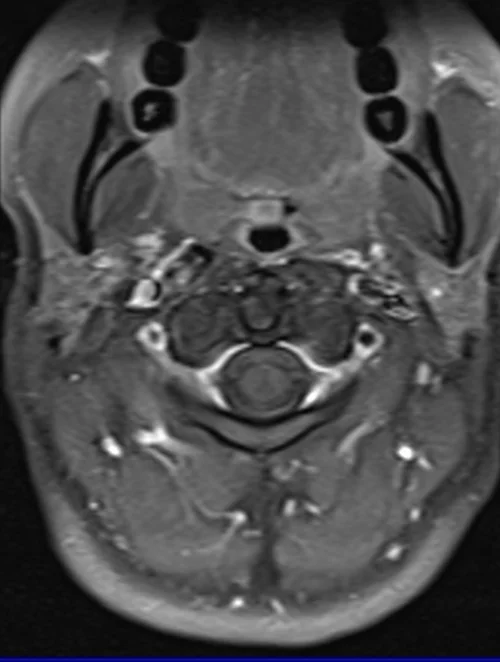 T1 POST GD C SPINE AXIAL 1 - MRI