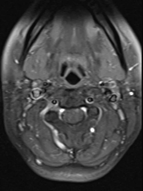 T1 POST GD C SPINE AXIAL 2 - MRI