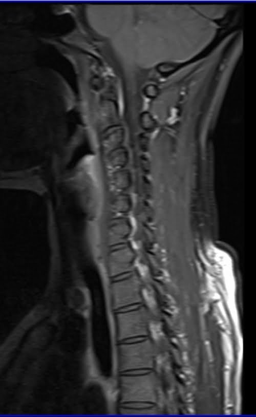 MRI cervical spine sagittal T1 fat sat post contrast images