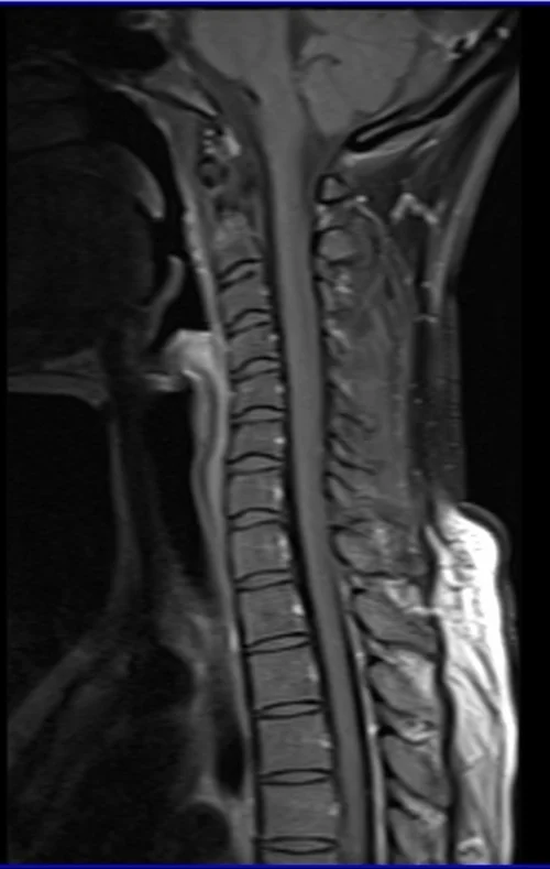 T1 POST GD C SPINE SAG 2 - MRI