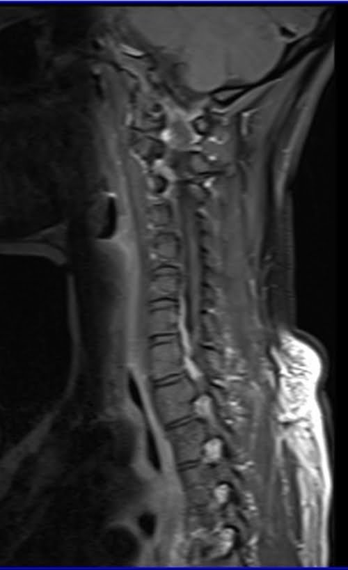 MRI cervical spine sagittal T1 fat sat post contrast images