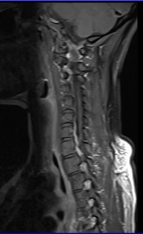 T1 POST GD C SPINE SAG 3 - MRI