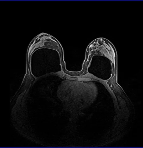 breast implant MRI axial dynamic 1 pre - MRI