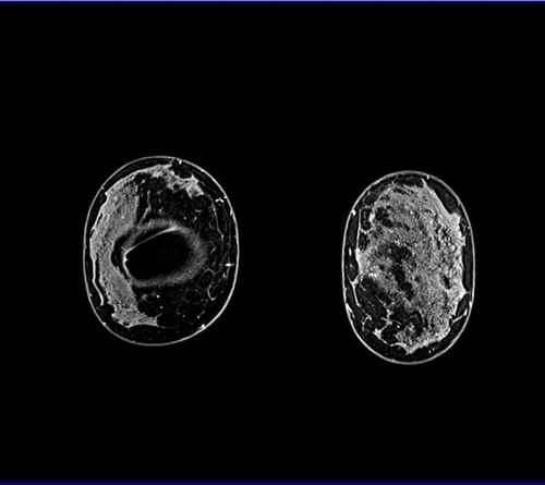 breast implant MRI coronal 1 - MRI