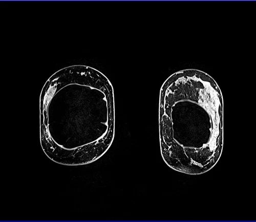 breast implant MRI coronal 2 - MRI