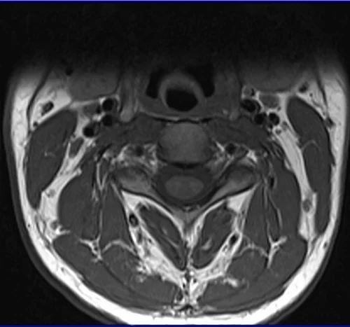 c spine axial t1 image 1 - MRI