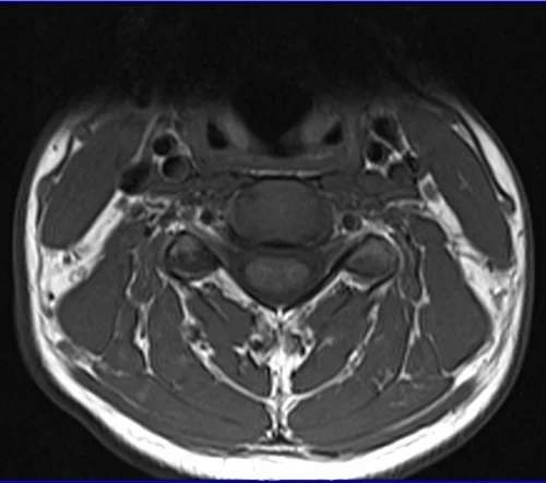 c spine axial t1 image 2 - MRI