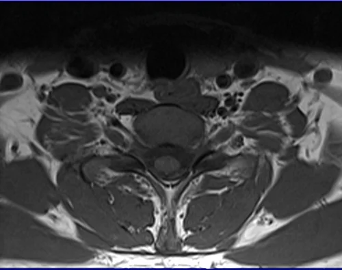 c spine axial t1 image 3 - MRI