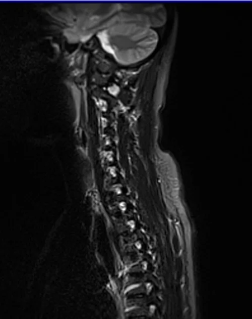 c spine sag stir image 1 - MRI