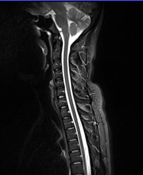 c spine sag stir image 2 - MRI