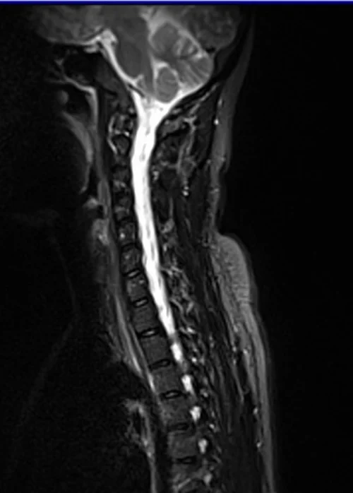 c spine sag stir image 3 - MRI