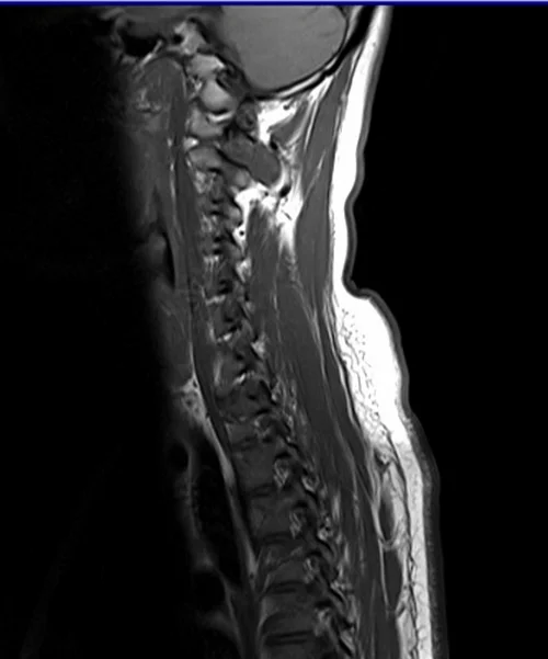 c spine sag t1 image 1 - MRI