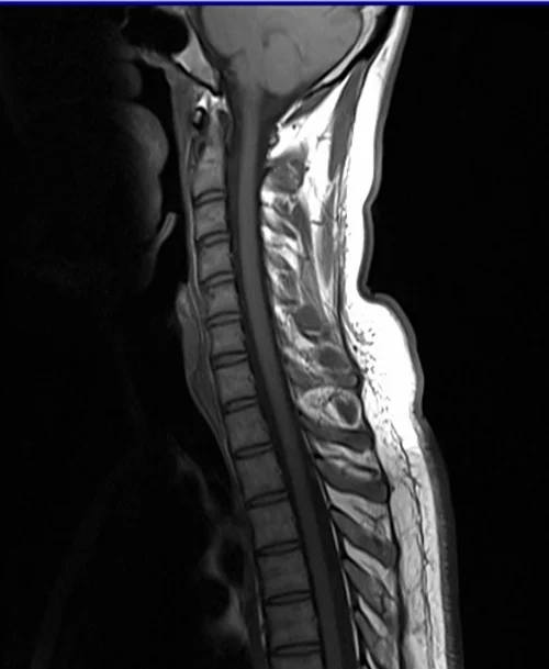 c spine sag t1 image 2 - MRI