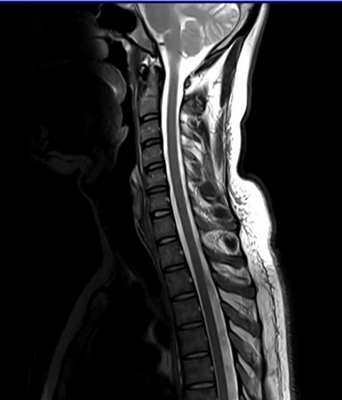 c spine sag t2 image 2 - MRI