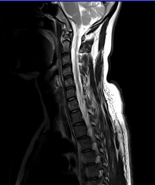 c spine sag t2 image 3 - MRI