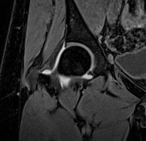 PLAN ARTHROGRAM HIP vibe coronal 3d - mrimaster