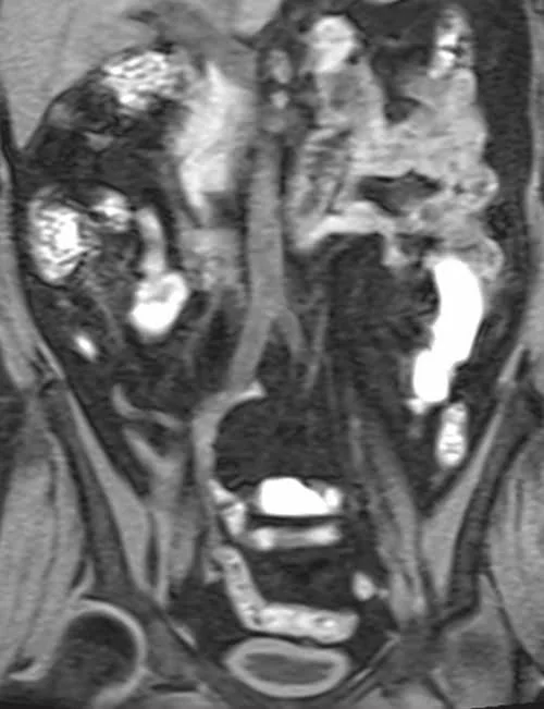 coronal vibe urogrpahy image 1 - MRI