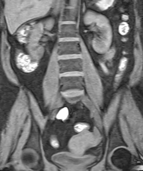 coronal vibe urogrpahy image 3 - MRI