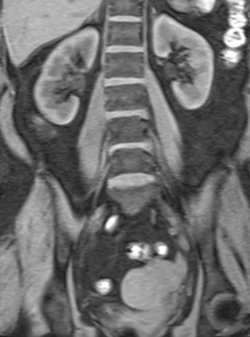 coronal vibe urogrpahy image 4 - MRI