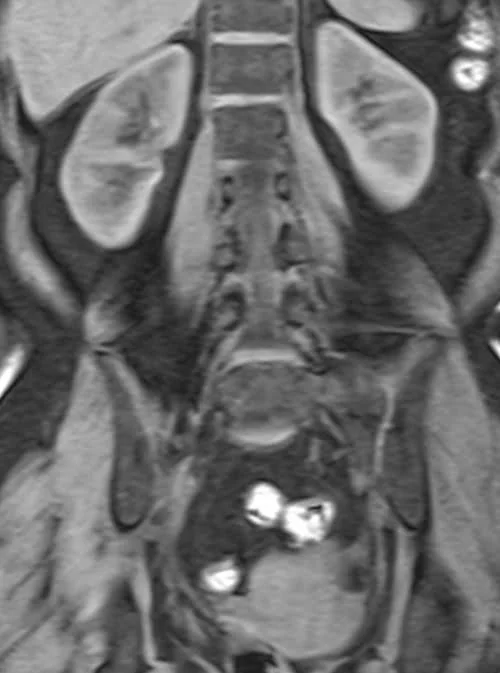 coronal vibe urogrpahy image 5 - MRI