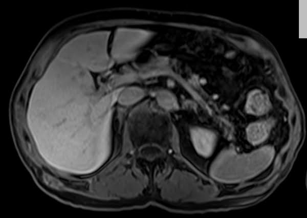 dynamic mri liver