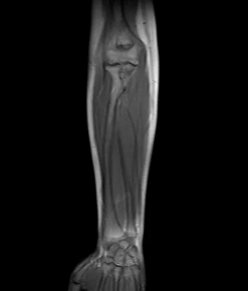 forearm localizer 3 - MRI