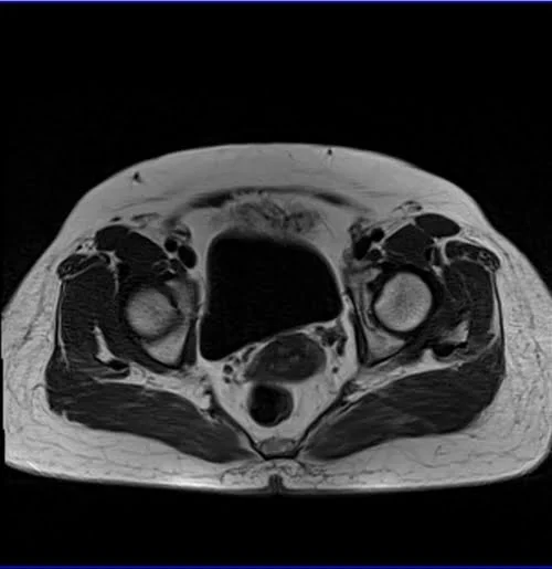 gyne pelvis ca endometrium axial big fov t1 1 - MRI