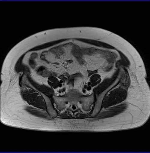 gyne pelvis ca endometrium axial big fov t1 2 - MRI